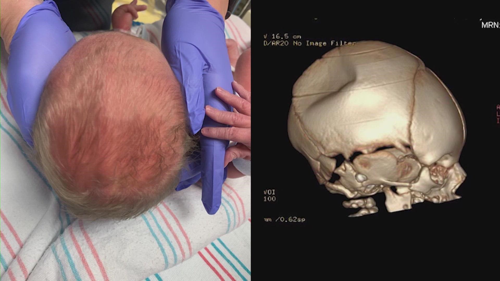 Doctors say it is very rare for babies to be born with a depressed skull fracture. It is typically treated with brain surgery.