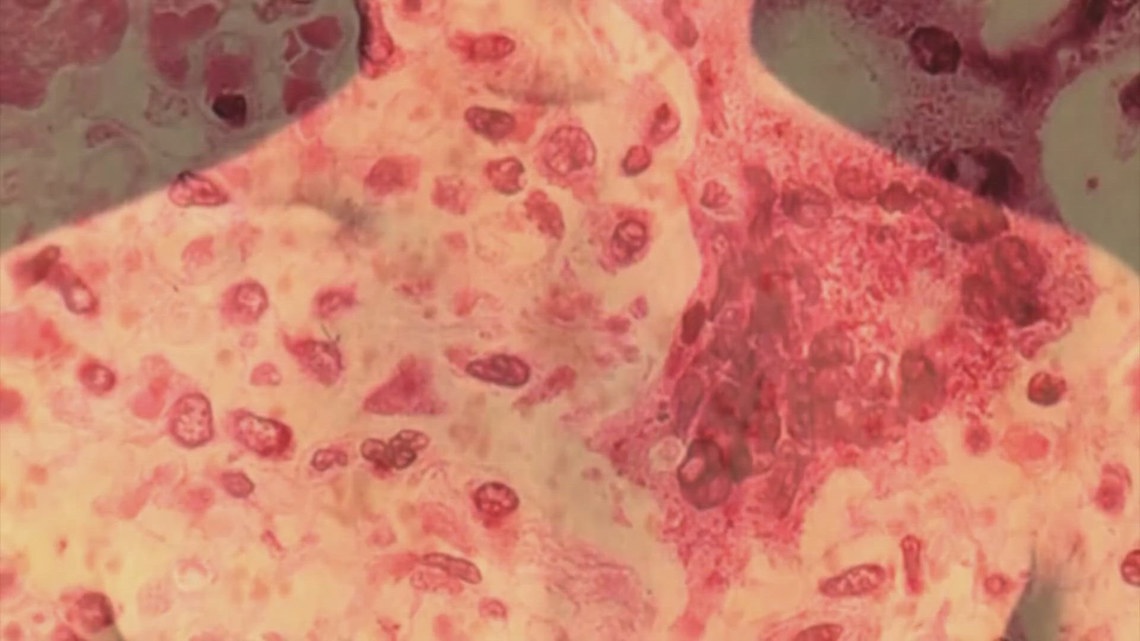 LDH confirms second measles case in the Greater New Orleans area