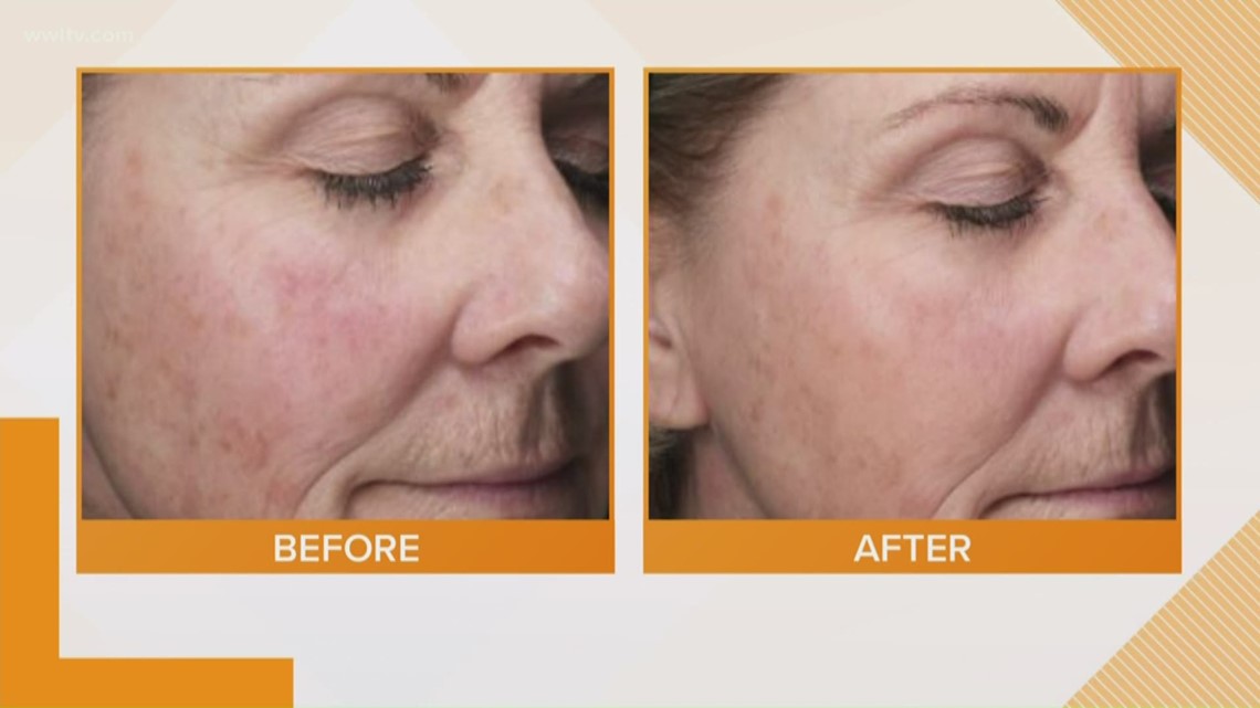 Skin Changes During Menopause