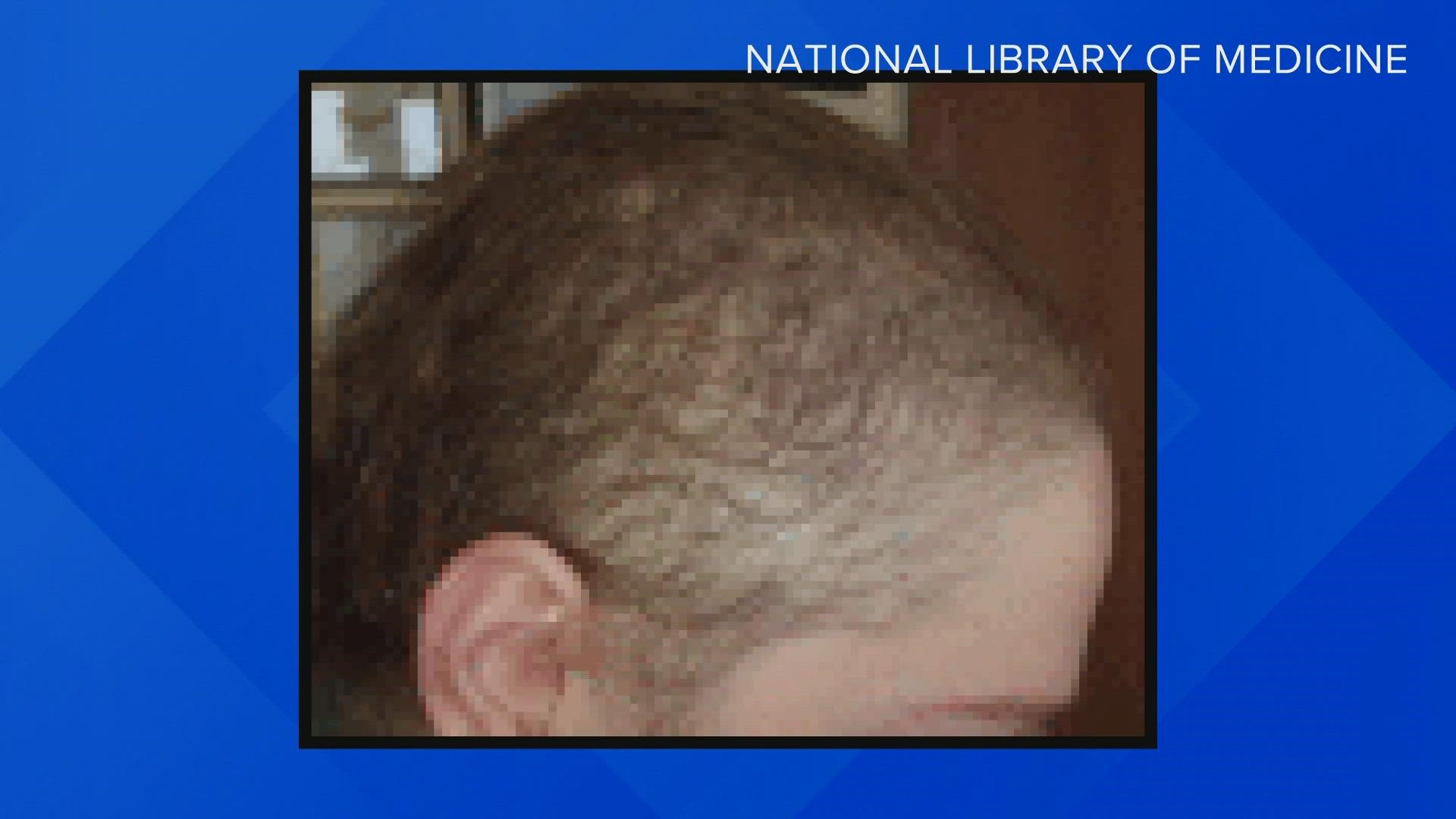 Hair loss a possible COVID side effect, but it's temporary 
