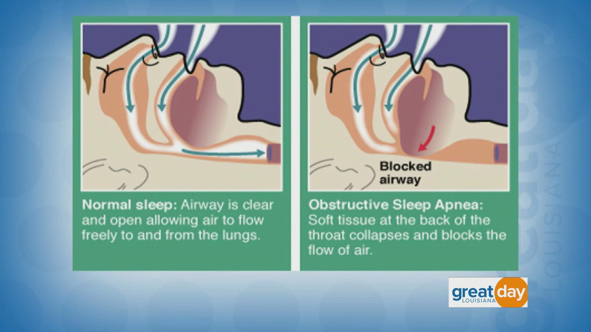 The Sleep Center of New Orleans shared how someone develops obstructive sleep apnea, how it is diagnosed and how to manage it.