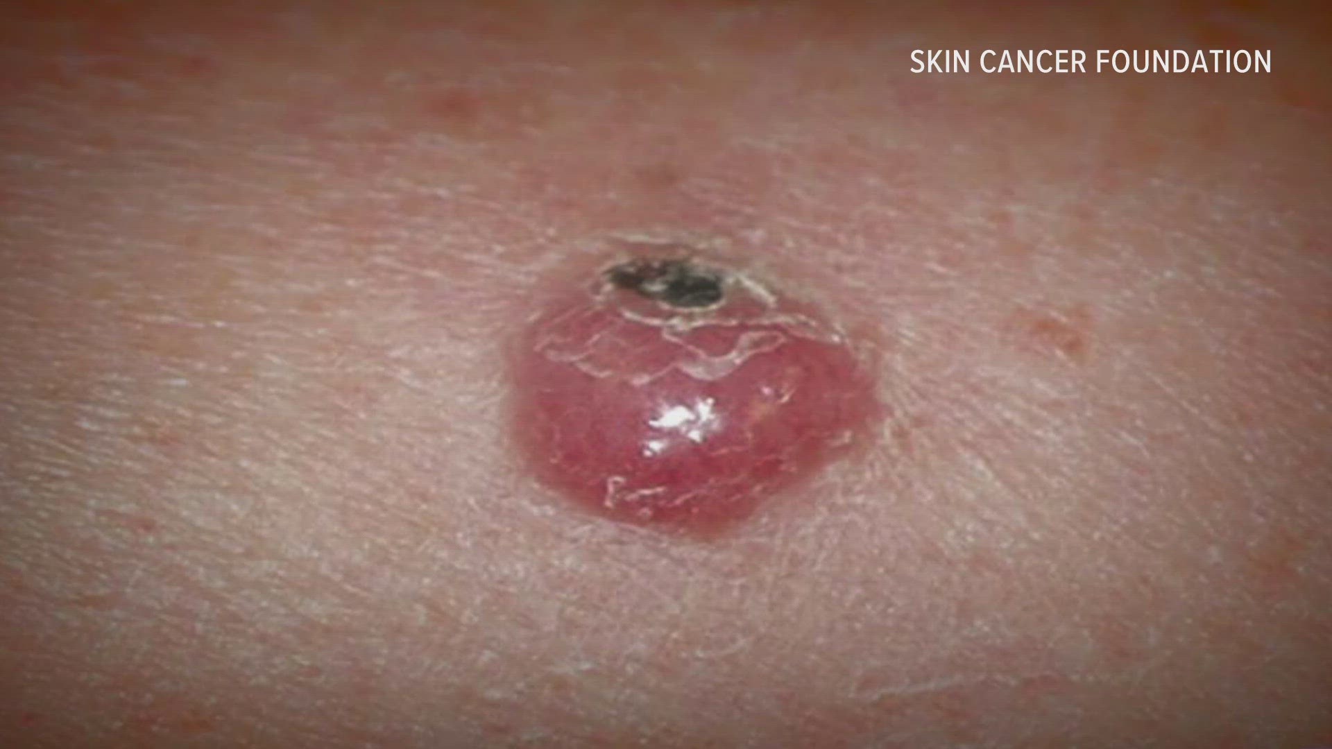 Many people have never heard of Merkel cell carcinoma, the rare form of skin cancer that took the life of Jimmy Buffet, but Al Copeland, Jr. is very familiar with it
