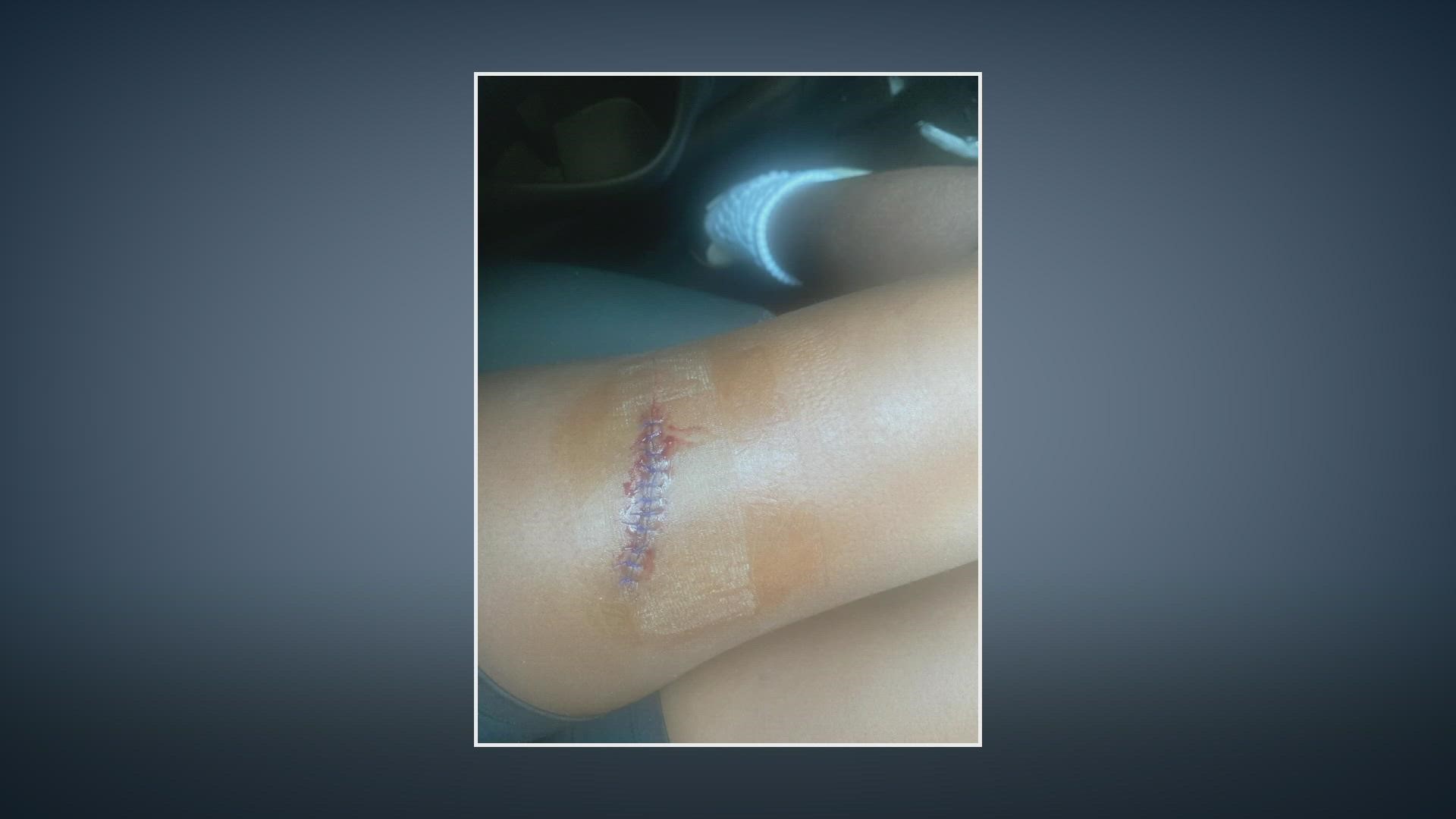 The wounded 16-year-old student was rushed to the emergency room, where she required more than 20 stitches to sew up a wound to her left thigh.