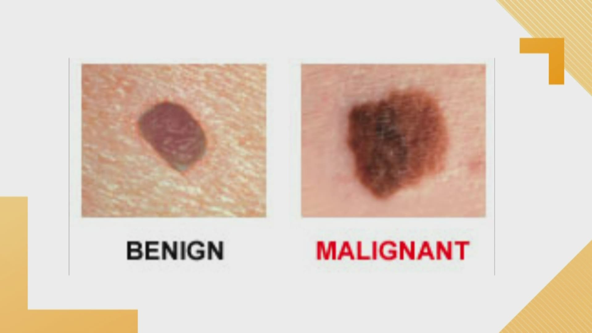 Dr. Patricia Farris goes through some of the warning signs you should be aware of when it comes to Skin Cancer on this Melanoma Monday.