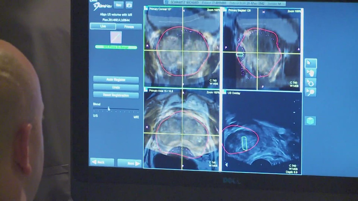 New study changing treatment for men with prostate cancer | wwltv.com