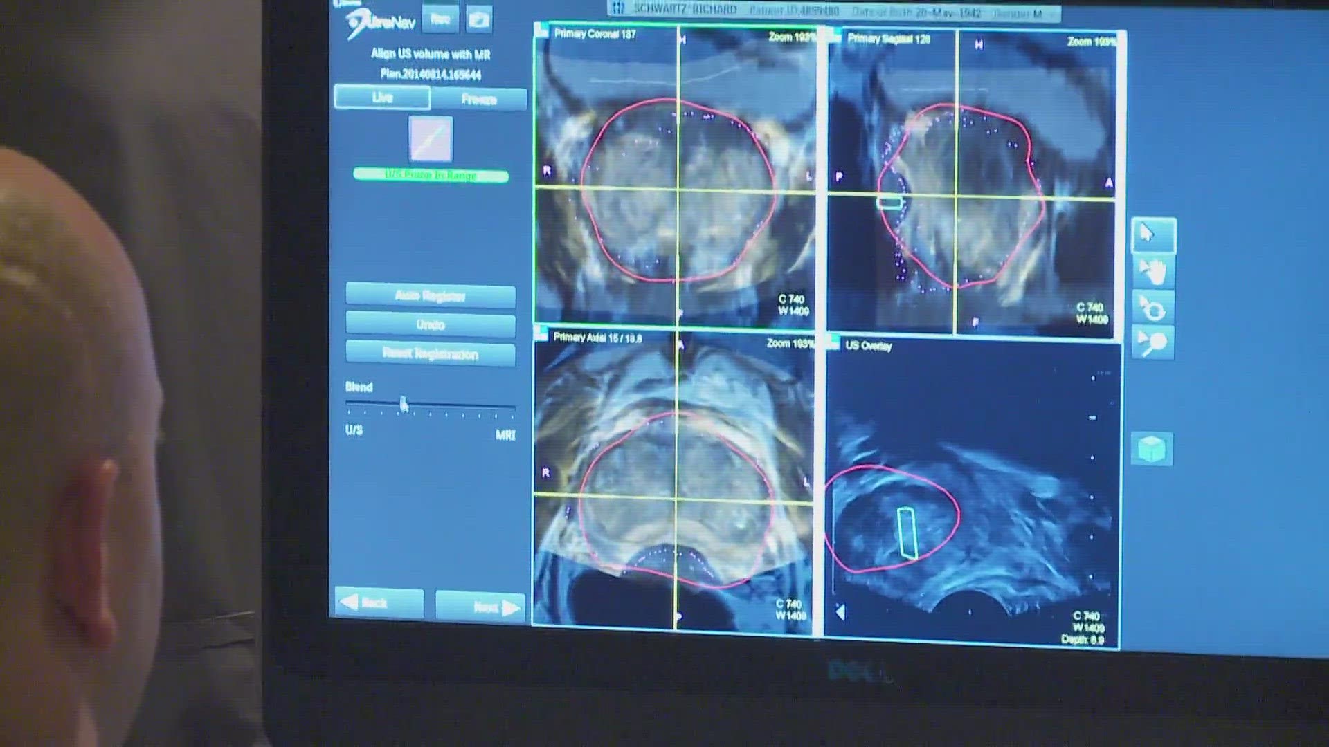 Prostate cancer specialist, Dr. Sartor says the study in the New England Journal of Medicine followed men with low-grade prostate cancer.