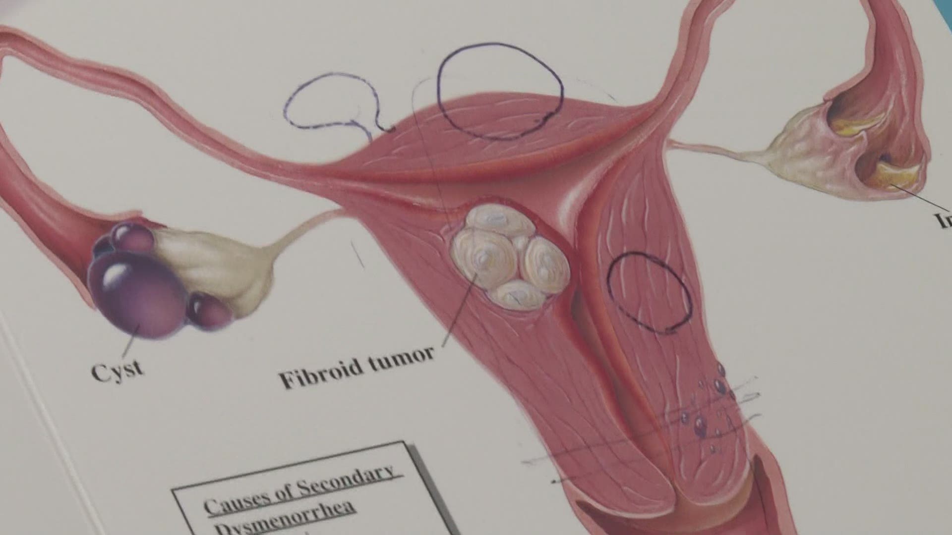 How to know if you have fibroids