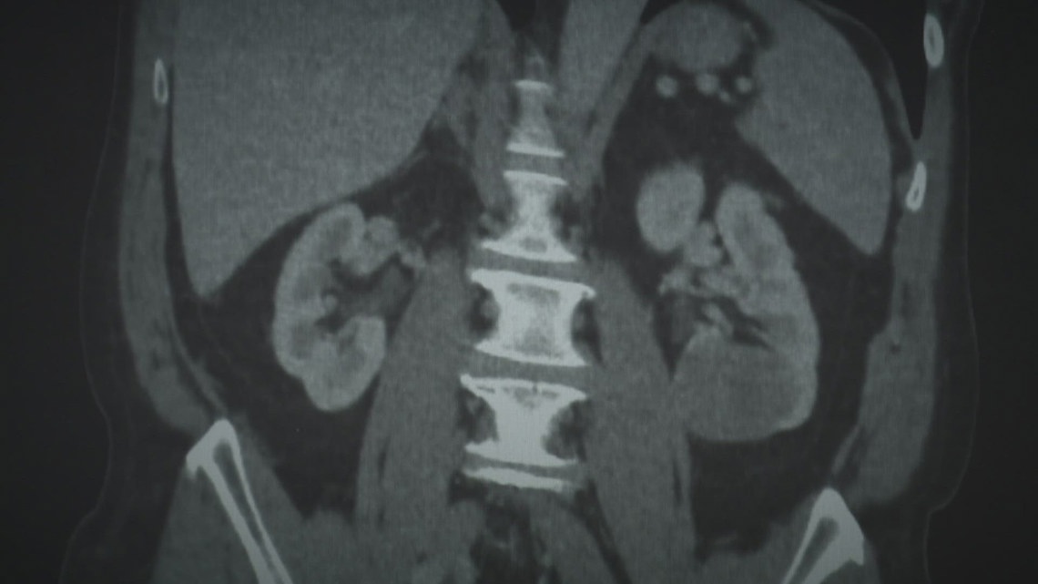 Ochsner researching whether a blood test can find hidden cancers