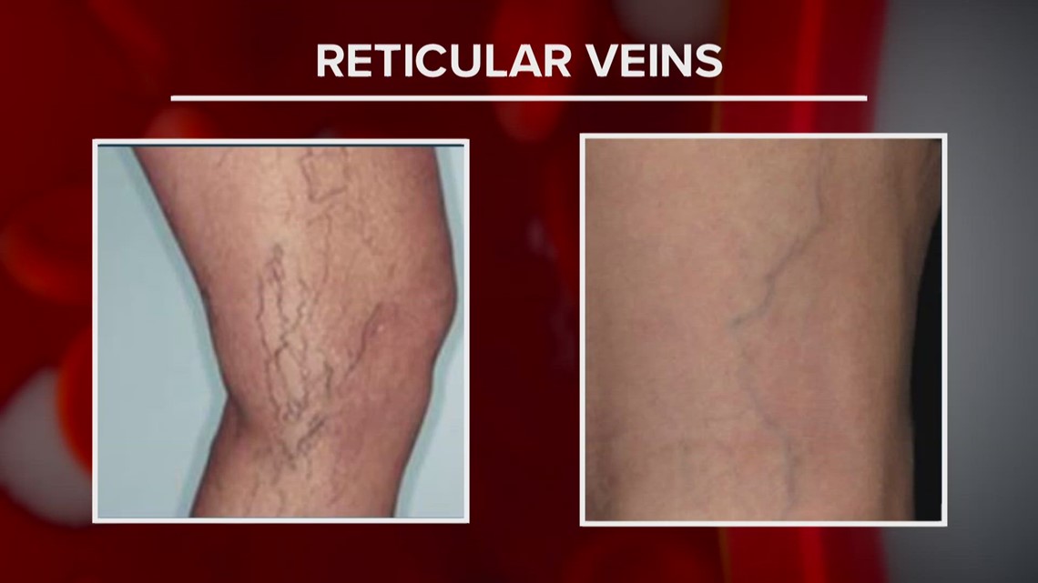 Treatable leg vein conditions often not diagnosed