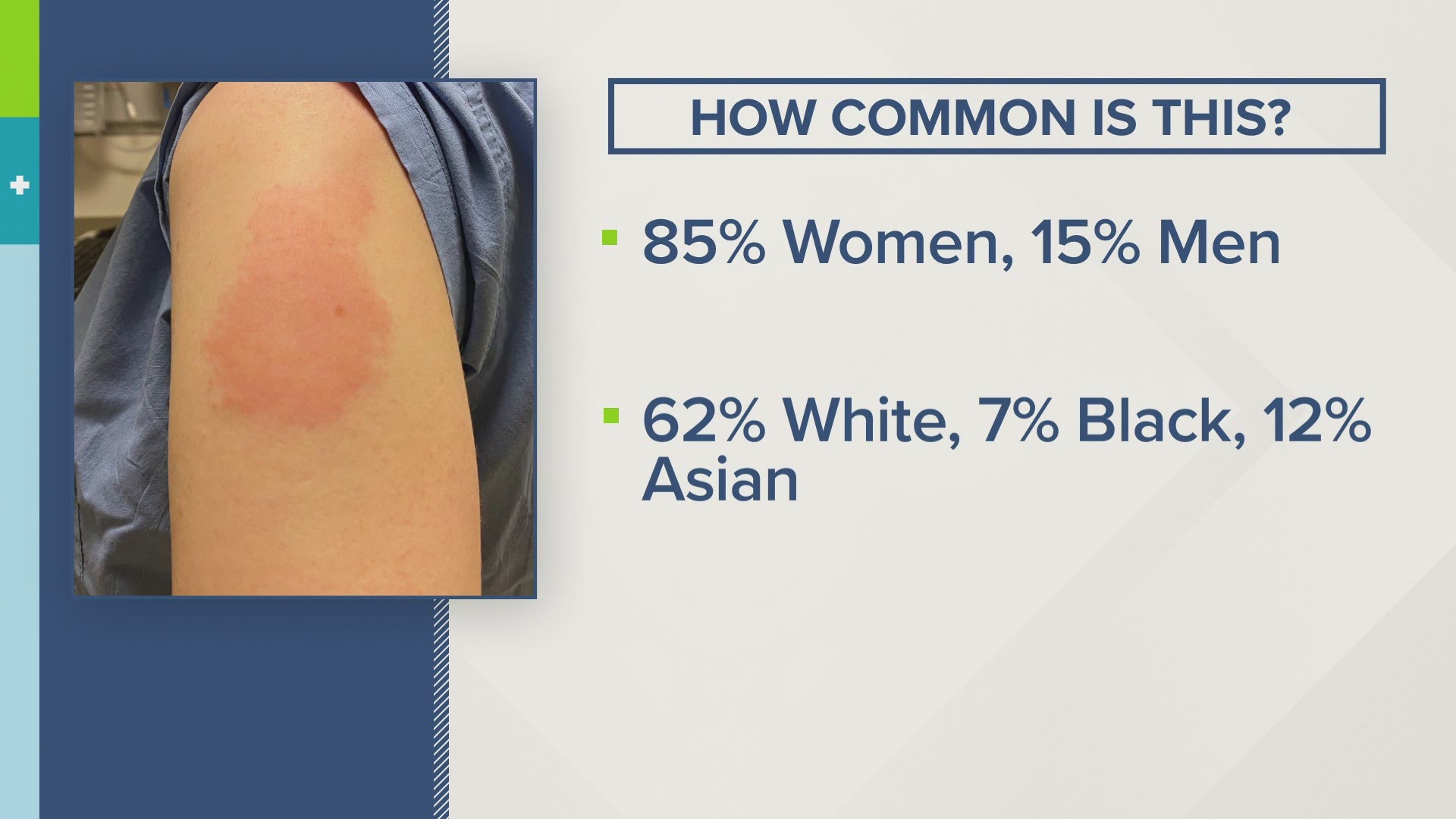 2% of people get skin irritation after COVID vaccines. Here's why