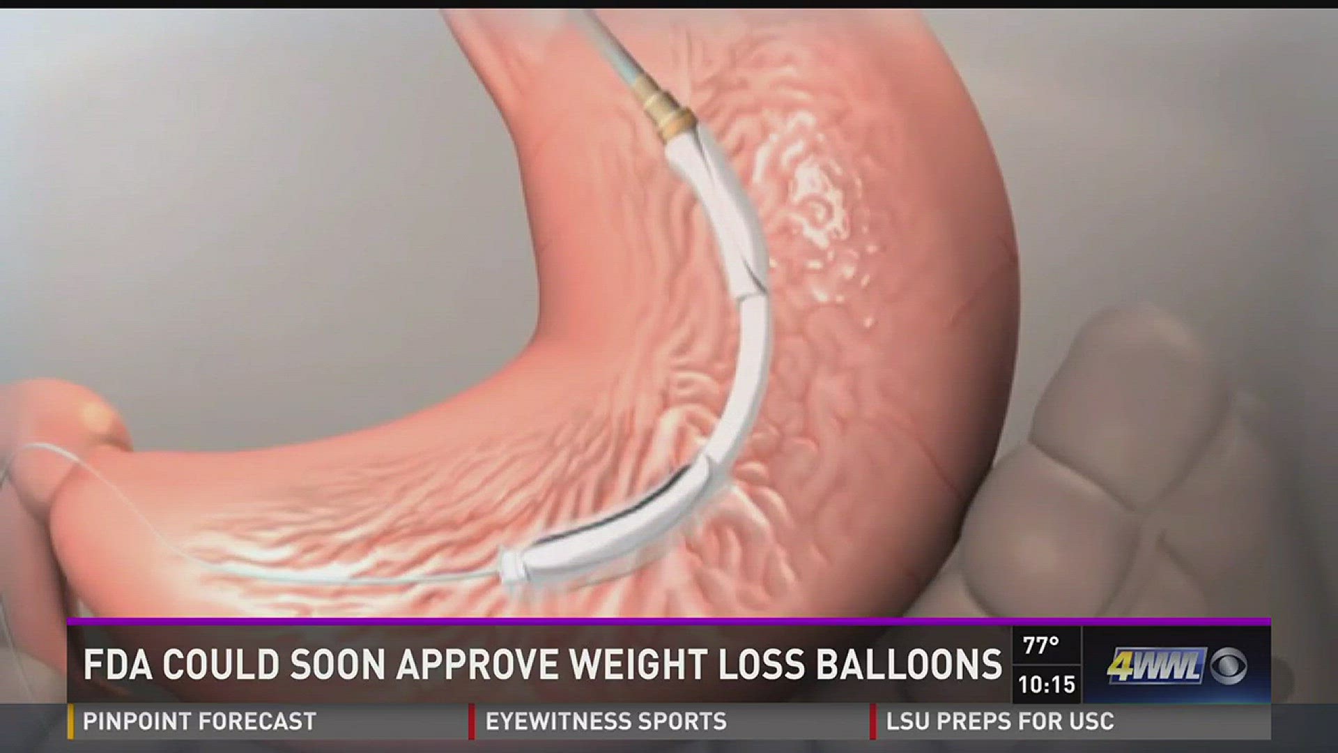 You've heard of weight loss surgery for obesity, but any day now, a new device to help people who are overweight could get FDA approval.
