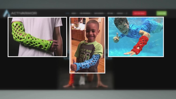 First Louisiana patient gets a 3D-printed, custom-fit cast