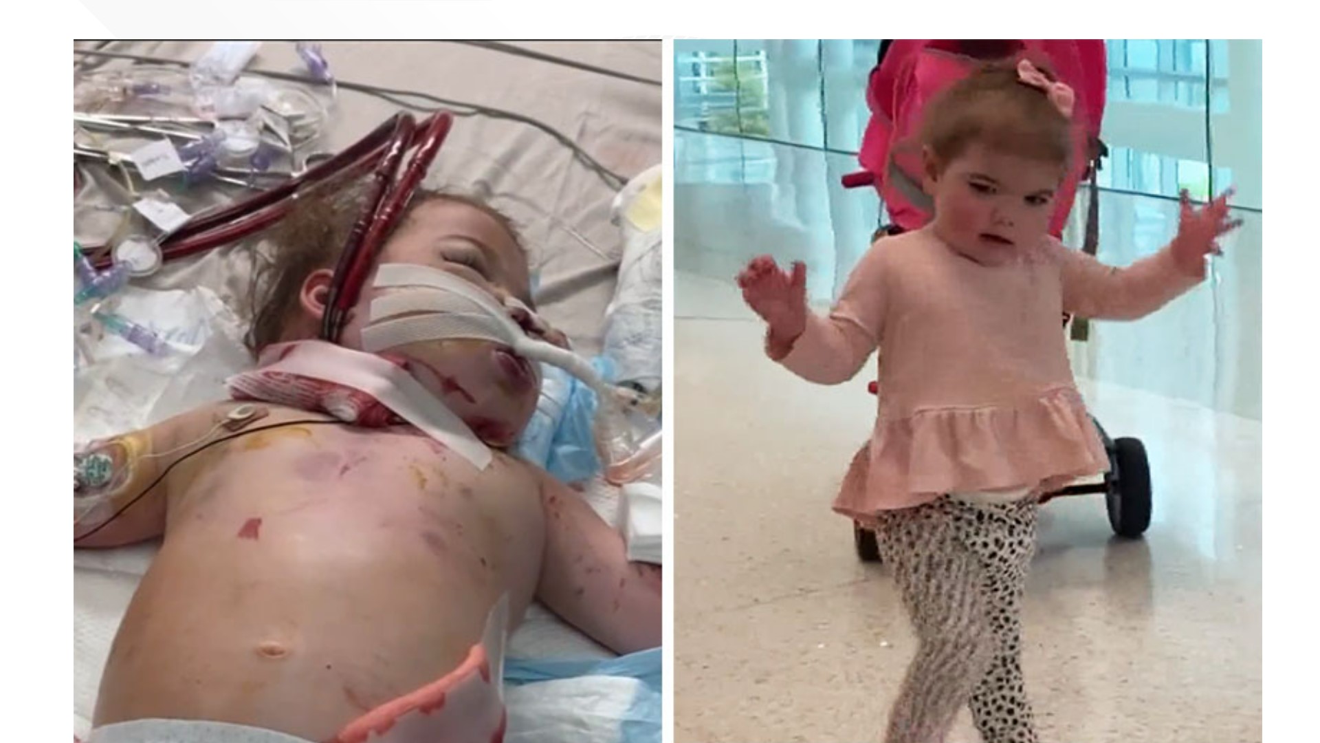 The dancing toddler developed an extremely rare life-threatening infection but has experienced a miraculous near-total recovery.