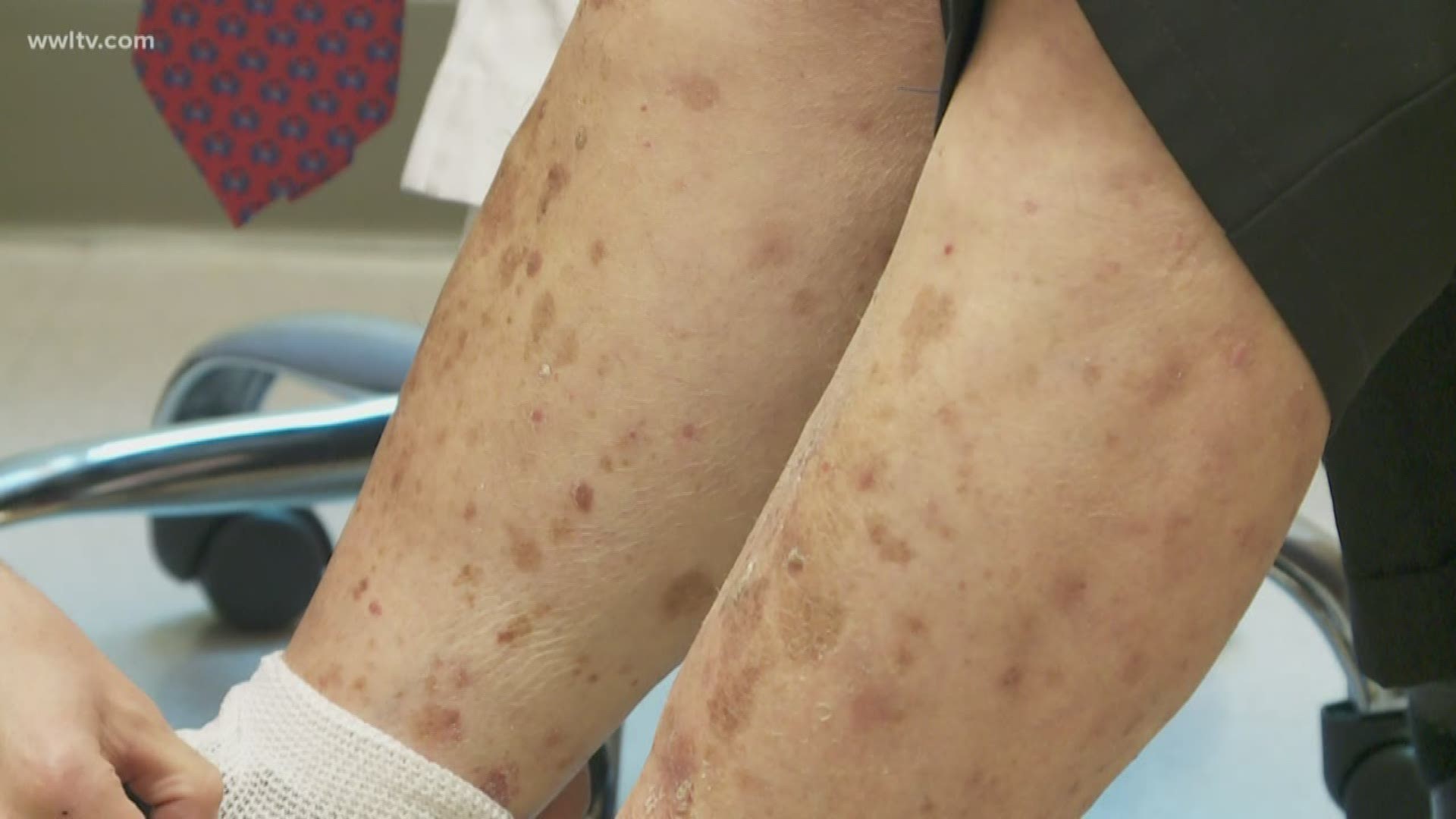 People with psoriasis use creams and pills to try and combat the constant, itchy lesions that pop up on their skin.