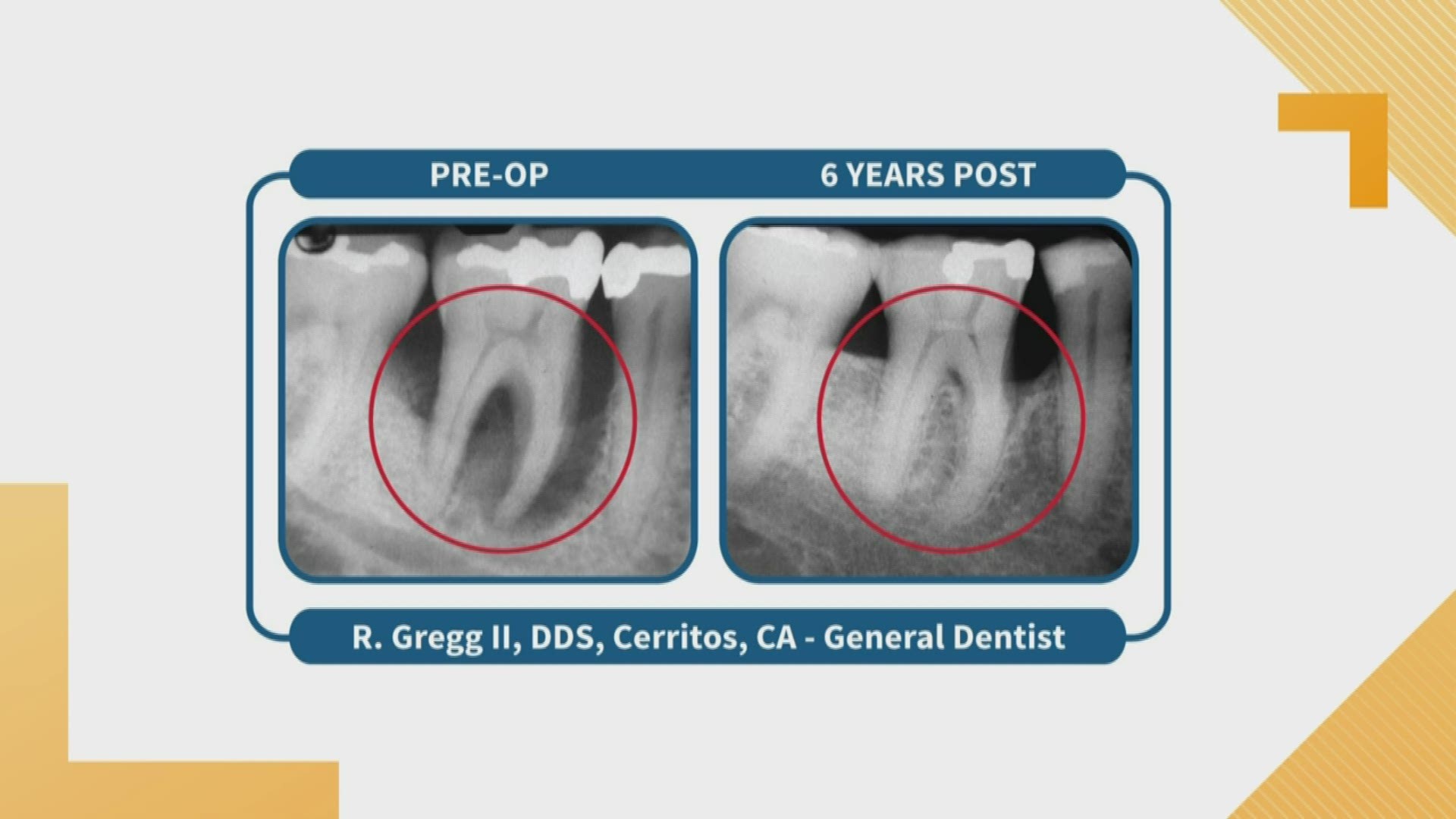 Dr. Ana Saenez has a new way to stop gum disease and lessen the chances of damage that it can do to the rest of your body. It's called the LANAP protocol procedure.