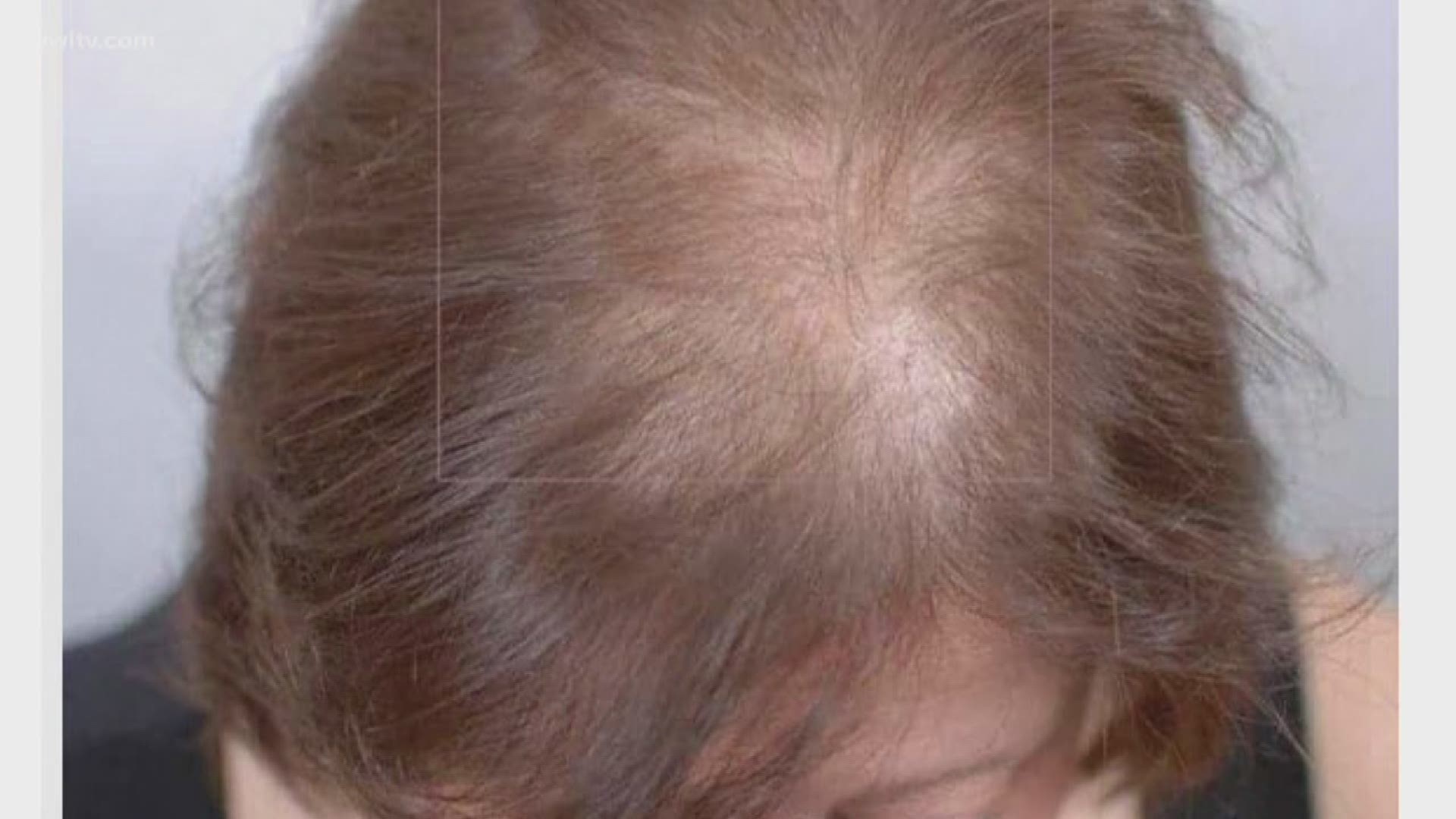 New supplement is getting results for patients with thinning hair |  