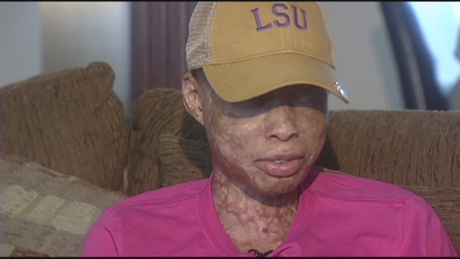 College student living with lifelong disfiguring injuries sues drug company