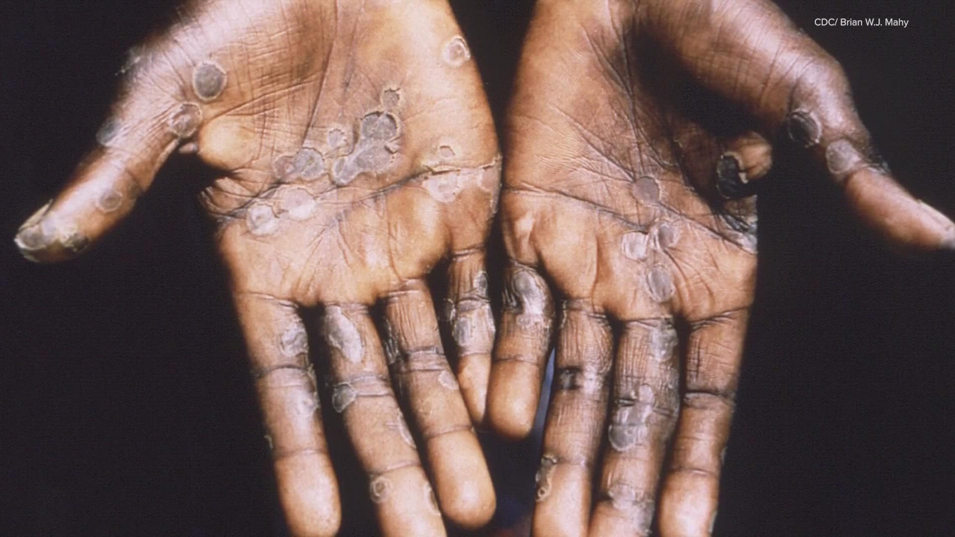 Louisiana now has it's first case of Monkeypox and it's right here in the New Orleans area.