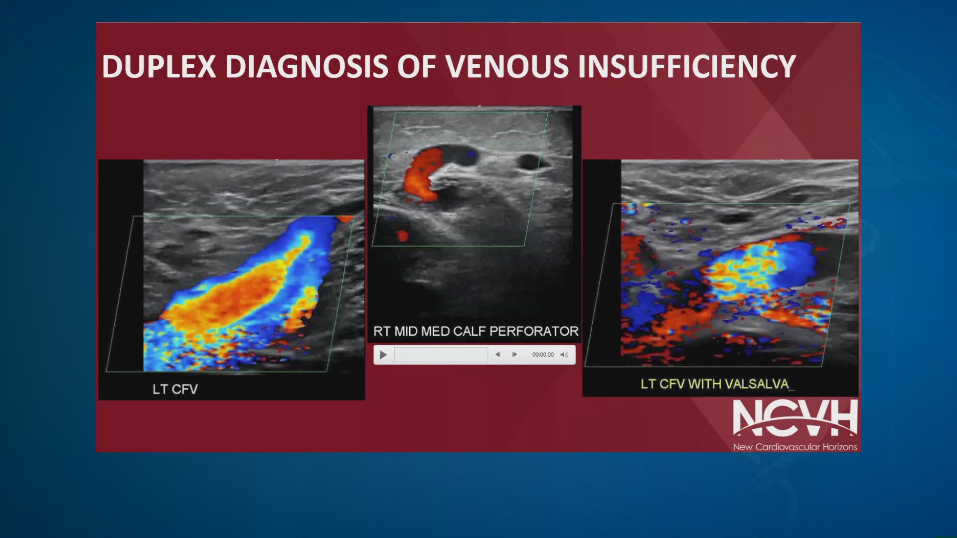 President Trump's diagnosis sheds light on common vein condition ...